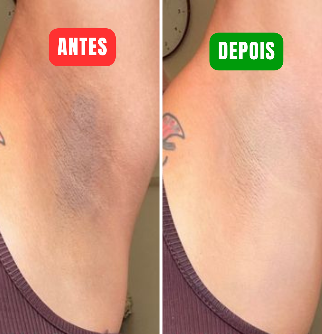 Lakerain Orange - Elimine às manchas escuras e marcas de acne em minutos!