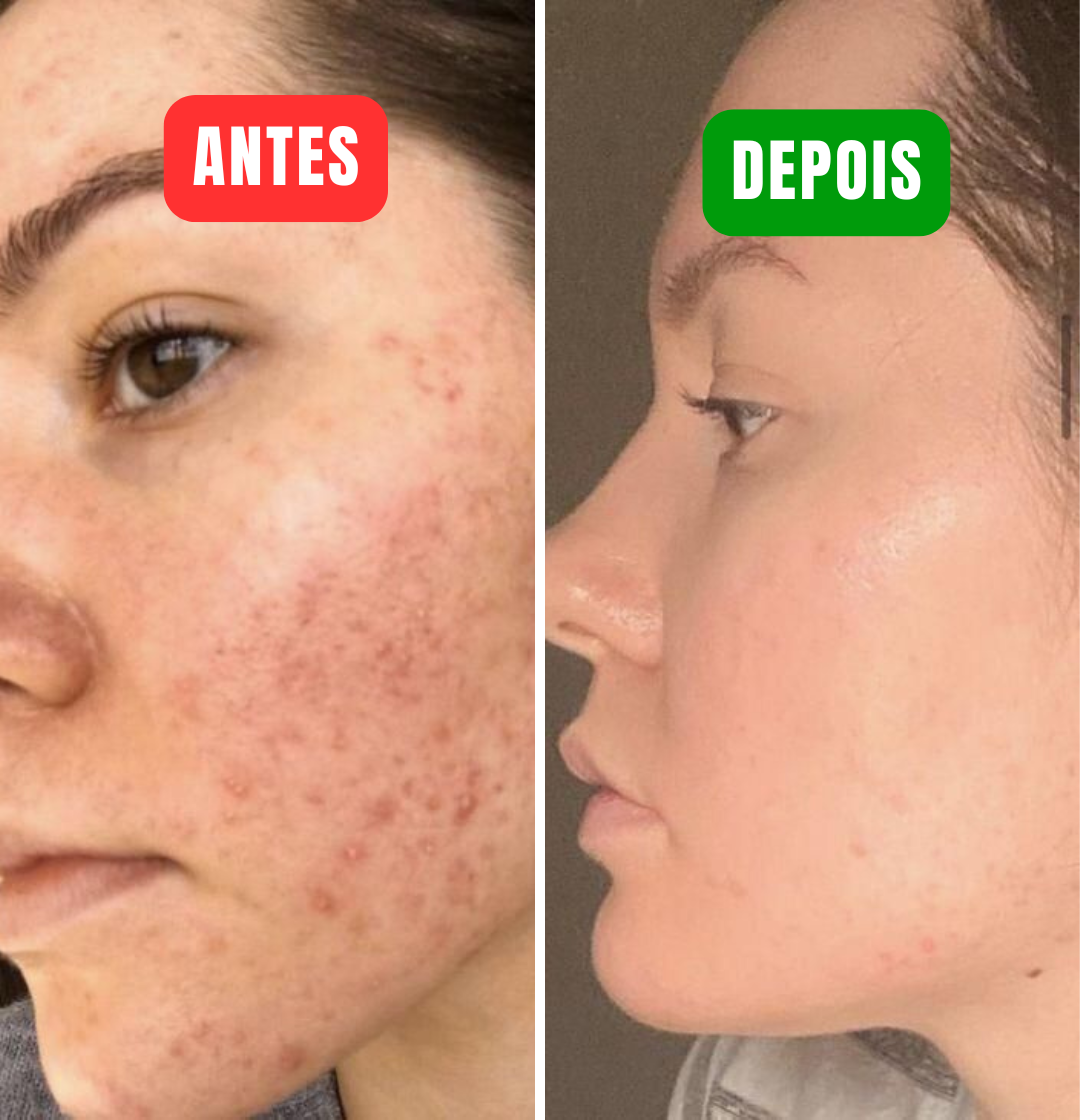 Lakerain Orange - Elimine às manchas escuras e marcas de acne em minutos!