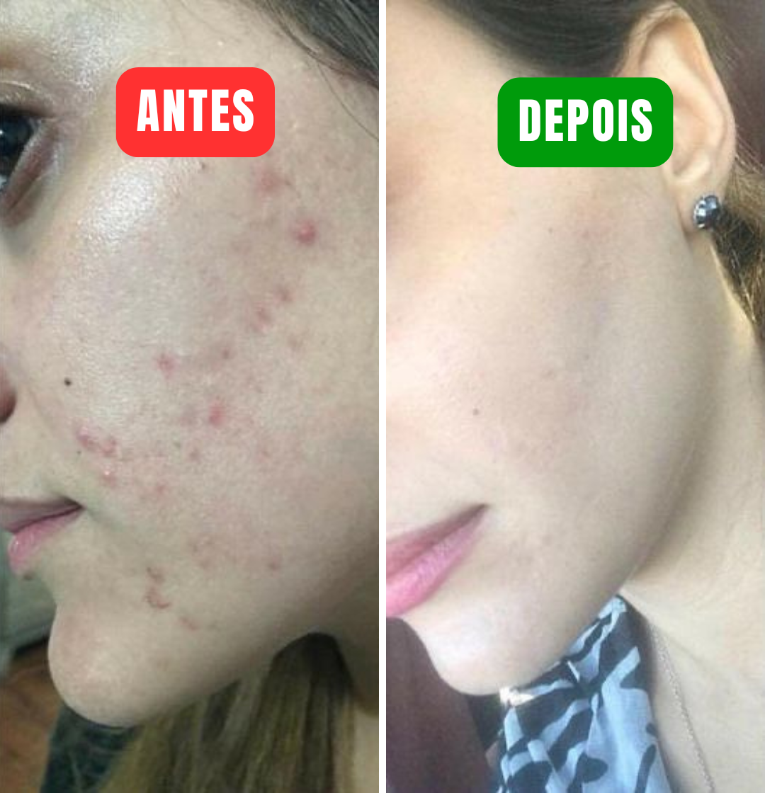 Centella - Acabe com manchas de acne em minutos!