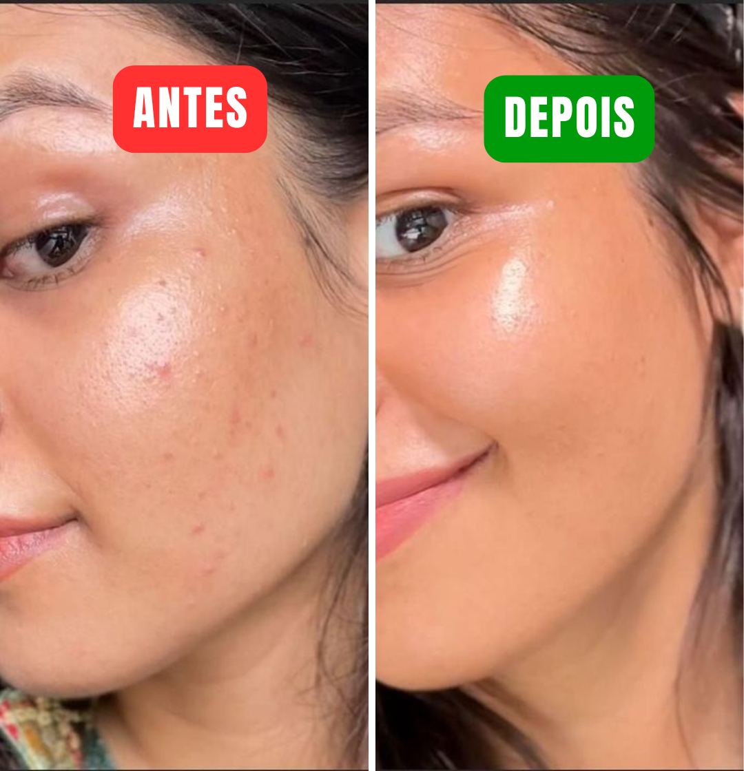 Centella - Acabe com manchas de acne em minutos!