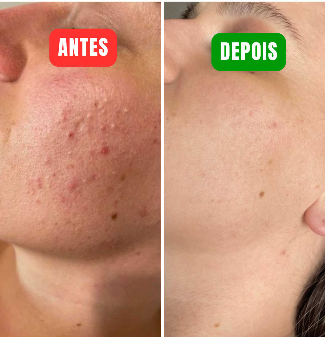 The Ordinary - Elimine manchas de acne em apenas 24h!