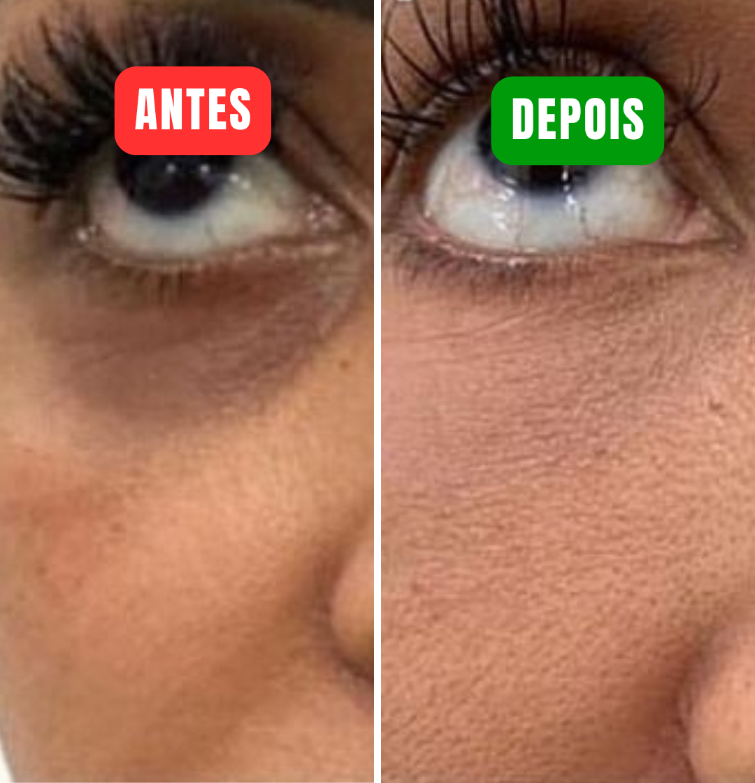 Lucence - Acabe com suas olheiras em minutos!