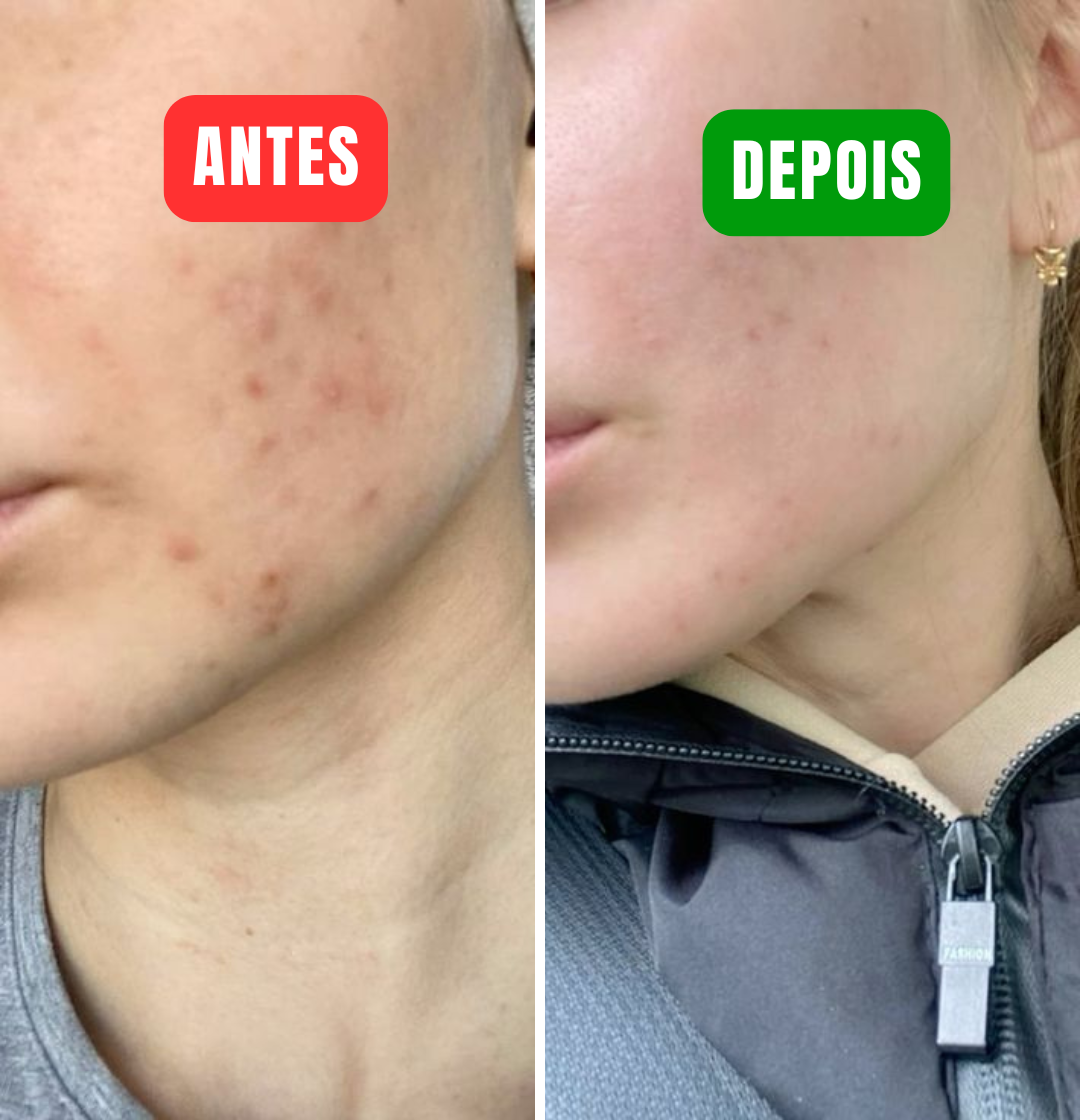 The Ordinary - Elimine manchas de acne em apenas 24h!