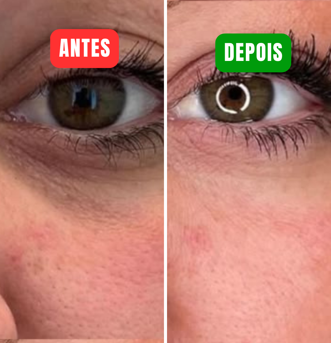 Lucence - Acabe com suas olheiras em minutos!