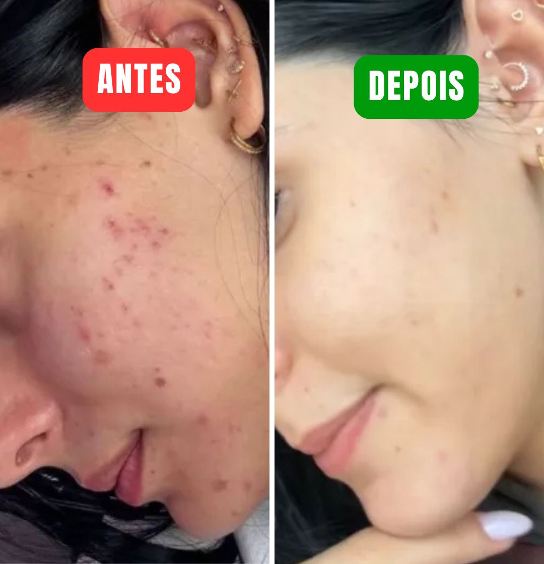 345 Cream - Elimine suas espinhas em minutos!