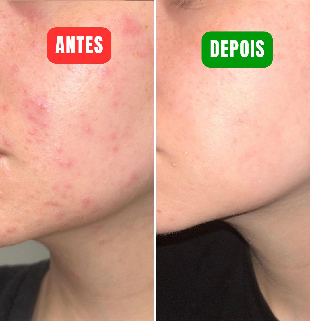 345 Cream - Elimine suas espinhas em minutos!
