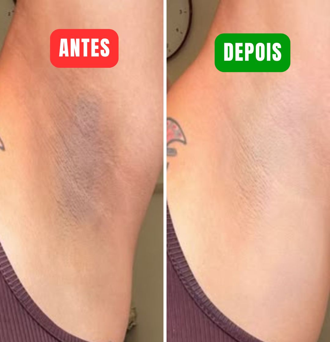NutralFit - Dê um fim nas manchas escuras em minutos!