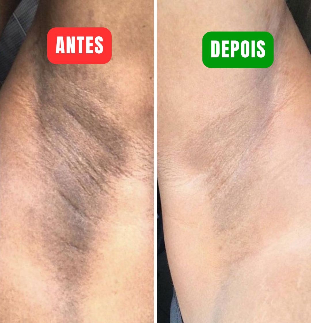 NutralFit - Dê um fim nas manchas escuras em minutos!